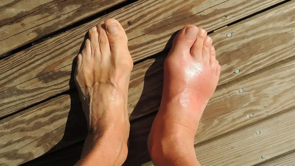 Cara Mengatasi Asam Urat Kambuh Tanpa Drama